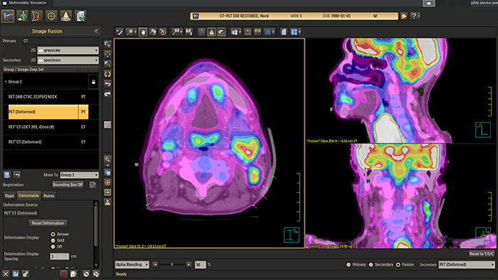 Philips expands radiation therapy simulation portfolio with MM Sim Advance and Mid-Position on Rembra RT