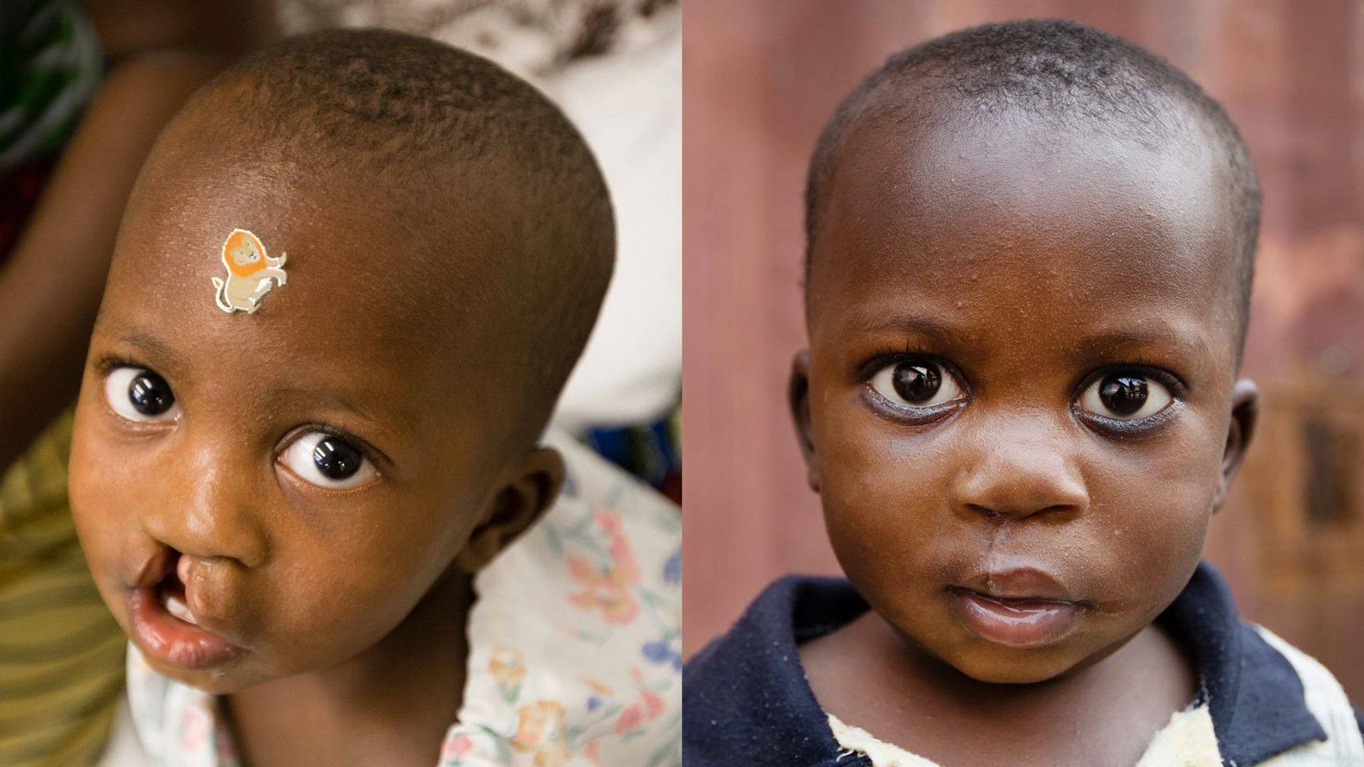 Bringing hope and healing in Africa through high-quality surgery 